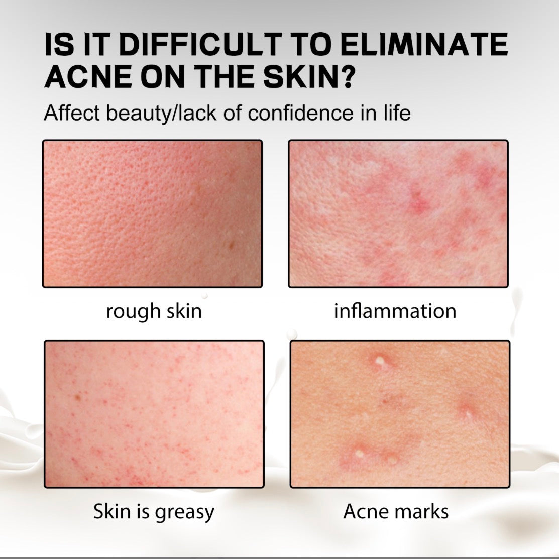 ClearBack Acne Cleansing Bar