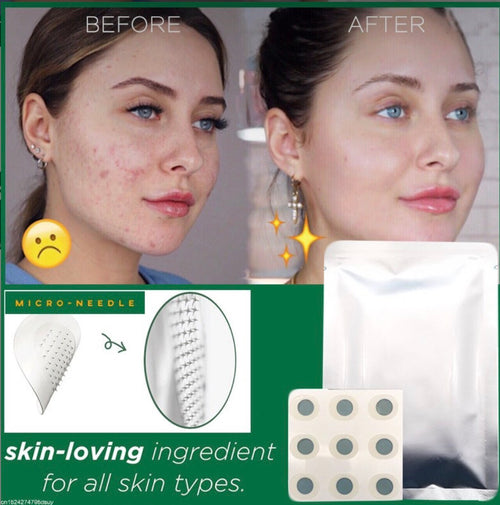 ClearNeedle Acne Patches